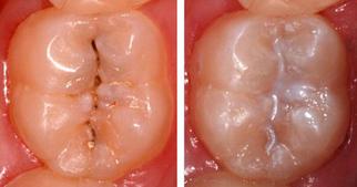 fissure sealants grooves dental fissures preventative sealant