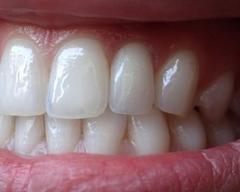 Prothèse Dentaire Fixe Zircon Sur Implants Michel Puertas Denturologiste Brossard-Laprairie, Fixed Denture On Implants Michel Puertas Denturologiste Brossard-Laprairie