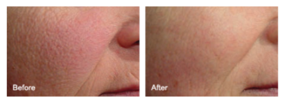 Cosmetic Injectables Center, Encino, Sherman Oaks Botox, Fillers, Restylane, Juvaderm, laser genesis, skin, pigmentation, redness, tightening, wrinkles