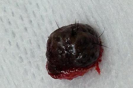 a picture showing a large black mole which was excised and placed on a piece of gauze