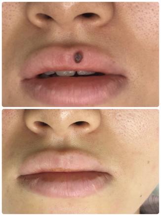 a before and after picture of laser removal of a dark colour mole on upper lip with minimal scarring