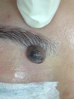 a big protruding mole located partially inside the right eyebrow