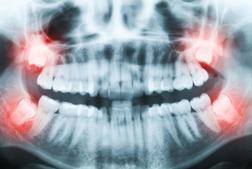 dents de sagesse wisdom teeth Brossard-Laprairie