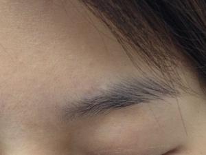 （手術切痣後）拆線２個月後，疤痕幾乎看不見