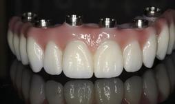 Prothèse Fixe Fix-On-Zircon Fixed Denture Fix-On-Zircon Brossard-Laprairie