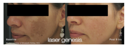Cosmetic Injectables Center, Encino, Sherman Oaks Botox, Fillers, Restylane, Juvaderm, laser genesis, skin, pigmentation, redness, tightening, wrinkles