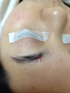 手術切除墨痣之後，可見一條傷口位於眉毛的上方