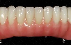 Fixed Denture On Implants Michel Puertas Denturologiste Brossard-Laprairie