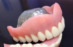 prothèse avec palais metallique Brossard-Laprairie, denture with metal palate Brossard-Laprairie