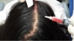 Encino, Cosmetic Injectables Center, PRP, PRF, Vampire facial, microneedling, collagen, skin, tightening, fine lines, wrinkles,