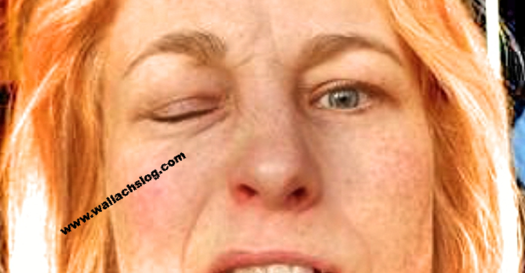 Facial Muscle Spasms - Dr. Joel Wallach