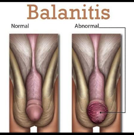 BALANITIS – Causes and Risk Factors, Clinical Manifestations and Management