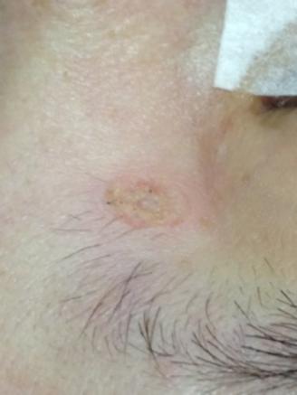 近鏡觀察激光脫墨後的傷口情況，沒有流血，毛囊保存良好，傷口很淺