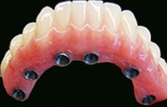 prothèse fixe sur implants Brossard-Laprairie, fixed denture on implants Brossard-Laprairie