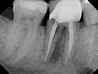 a) Visible fracture lines within the enamel suggestive of craze