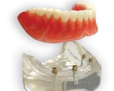 Prothèse Dentaire Sur Implants Michel Puertas Denturologiste Brossard-Laprairie, Denture On Implants Michel Puertas Denturologiste Brossard-Laprairie