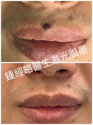 Comparison photo showing mole removal from upper cutaneous lip