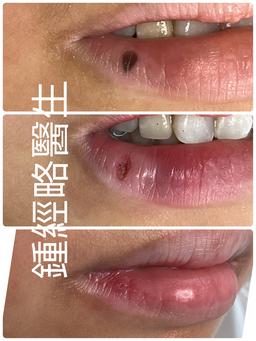 激光脫除位於右下唇的一粒平坦的黑色的墨痣的過程的三幅照片