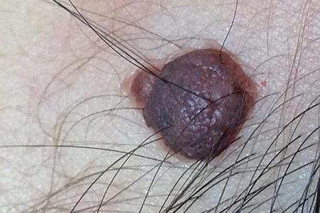 A dark brown, hair-bearing raised mole located on the neck