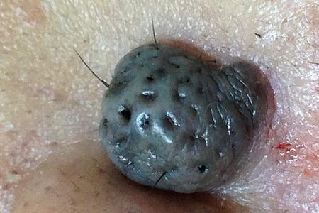 a close up shot of the large black mole which has huge pores on the surface and hairs growing from it