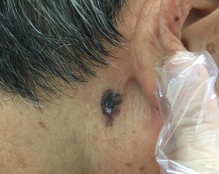 back of ear skin caner 耳背皮膚疣