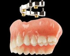 Prothèse Dentaire Sur Implants Avec Barre Michel Puertas Denturologiste Brossard-Laprairie, Denture On Implants With Bar Michel Puertas Denturologiste Brossard-Laprairie