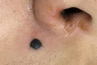 image of a black and protruding mole on the upper end of nasolabial fold
