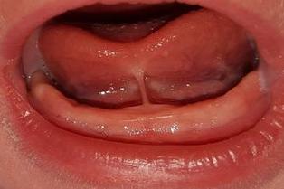 no frenulum tongue