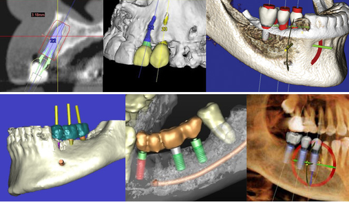 Scan 3D Clinique Implantologie Dentaire Brossard