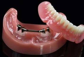 Denture On Implants With Bar Michel Puertas Denturologiste Brossard-Laprairie