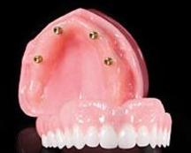 Prothèse Dentaire Sur Implants Michel Puertas Denturologiste Brossard-Laprairie, Denture On Implants Michel Puertas Denturologiste Brossard-Laprairie