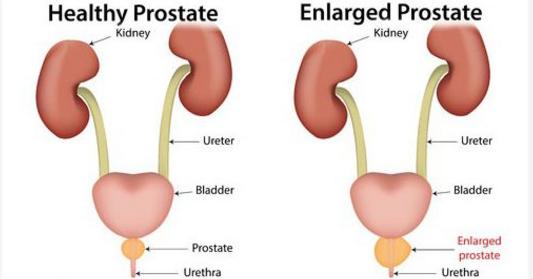 PROSTATITIS – Types, Causes and Risk Factors, Clinical Manifestations, Diagnostic Evaluations and Management