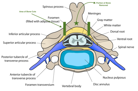 cervical laminectomy