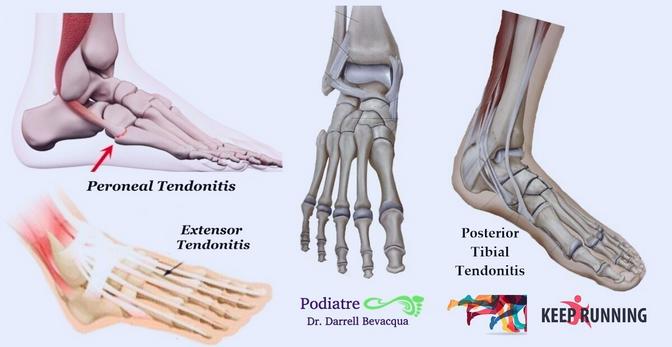 Best insoles for hot sale extensor tendonitis