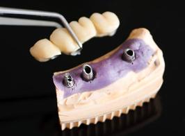 Bridge on dental implants Brossard-Laprairie