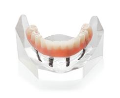 Denture On Implants Fix-On-4 Clinique Implantologie Dentaire