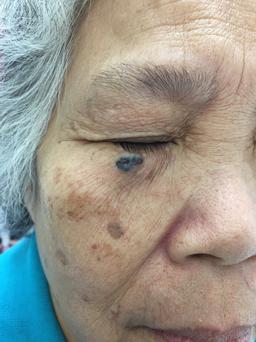 下眼皮皮膚癌 skin cancer on lower eyelid