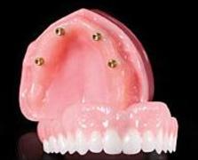 Denture On Implants Clinique Implantologie Dentaire