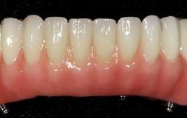 Fixed Denture On Implants Brossard-Laprairie