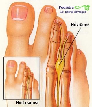 Névrome de Morton: Orthèses, Traitements & Solutions