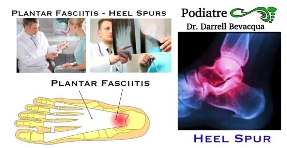 Plantar Calcaneal (Heel) Spurs - Sports Podiatry Info