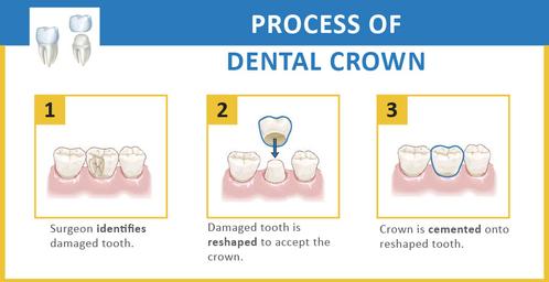 Dental Crown Cody WY