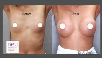 Breast implants before and after photos
