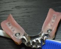 PROTHÈSE DENTAIRE AMOVIBLE SUR IMPLANTS REMOVABLE DENTURE ON IMPLANTS Brossard-Laprairie