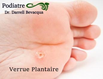 Verrue Plantaire Traitements Expert Podiatre Spécialiste