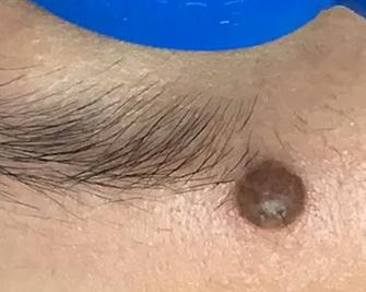 a mole located on the forehead, positioned superior to the medial aspect of the left eyebrow
