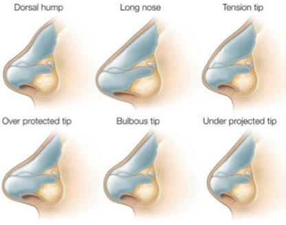 Indications for rhinoplasty