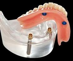 Denture On Implants Michel Puertas Denturologiste Brossard-Laprairie