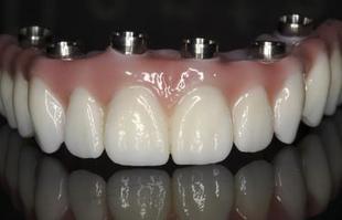 Denture Fix-On-Zircon Michel Puertas Denturologiste Brossard-Laprairie