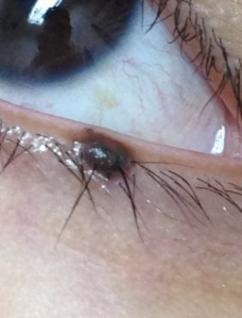 a black skin mole on the external margin of left lower eyelid (the lash line)